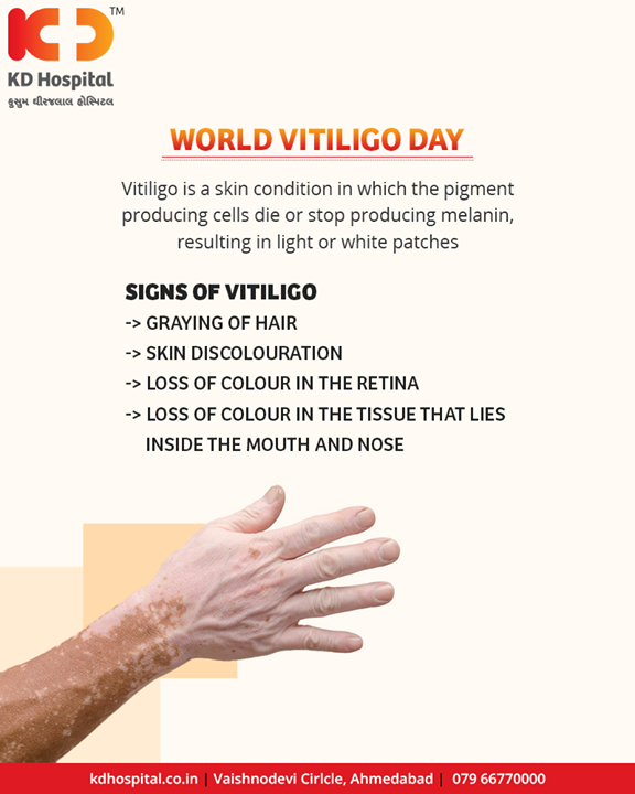 Vitiligo is a skin condition in which the pigment producing Cells die or stop producing melanin, resulting in light or white patches‬‬‬‬

#WorldVitiligoDay #KDHospital #Ahmedabad #Healthcare #GoodHealth