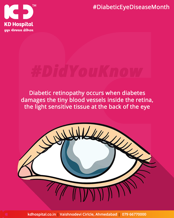 Diabetic retinopathy occurs when diabetes damages the tiny blood vessels inside the retina, the light sensitive tissue at the back of the eye

#DiabeticEyeDiseaseMonth #KDHospital #GoodHealth #Ahmedabad #Gujarat #India