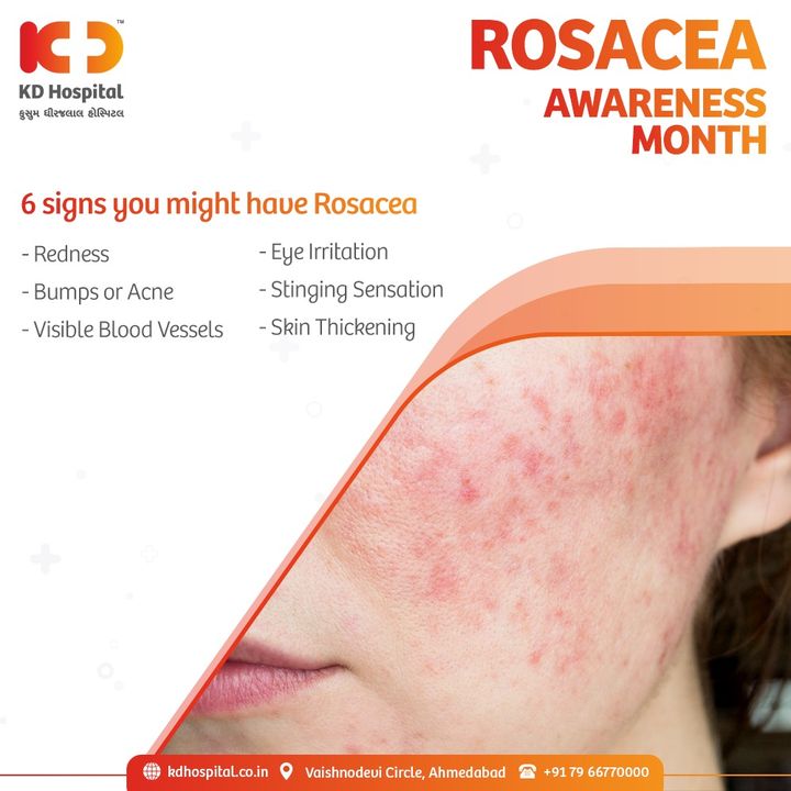 Rosacea awareness month means to raise awareness about this chronic facial disease to seek medical help for prompt diagnosis and treatment.

Seek medical help from our expert dermatologists for any skin-related problems. 
Call +917966770000 to book an appointment today.

#KDHospital #rosacea #rosaceatreatment #rosaceaawareness #rosaceaawarenessmonth #skincareroutine #skin #skincare #skincaretips #beauty #acne  #dermatology #dermatologist #HealthDay  #StayAware #StayAwareStaySafe #Diagnosis #goodhealth #healthfirst #healthylifestyle #wellness #wellnessthatworks #NABHHospital #QualityCare #hospitals #doctors #Nurses #healthcare #medical  #digitalmarketing #Ahmedabad #Gujarat #India