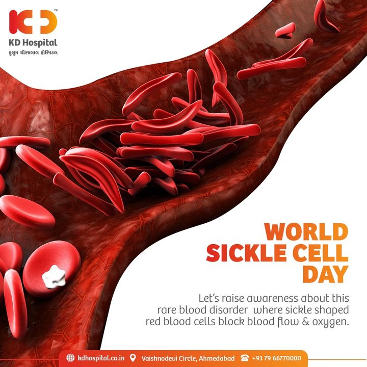 Sickle Cell is a rare genetic red blood cell disorder in which there aren't enough healthy red blood cells to carry oxygen throughout your body.
Early detection is a timely intervention.

#KDHospital #SickleCell #WorldSickleCellDay  #worldsicklecellday2021 #BloodCell #RedBloodCell #RBC #Diagnosis #Therapeutics #Awareness #wellness #goodhealth #wellnessthatworks #Nusring #NABHHospital #QualityCare #hospitals #healthcare #physicians #explore #surgeon #Ahmedabad #Gujarat #India