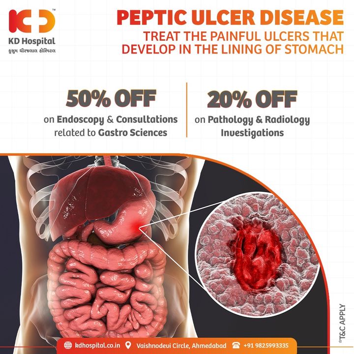 Ulcers occur when stomach acid damages the lining of the digestive tract. Though ulcers can sometimes heal on their own, you shouldn't ignore the warning signs.

Last few days remaining!
Get Access to concessional rates on Gastro Consultation till 15th August'21. If you have any such symptoms call +919825993335 to book your appointment.

#KDHospital #GastroSciences #GastroEnterology #GastroSurgery #Ulcer #PepticUlcer #Sores #Intestine #Stomach #StomachDiseases #Diagnosis #Awareness #goodhealth #Nusring #NABHHospital #QualityCare #hospital #explore #healthcare #physicians #surgeon #Ahmedabad #Gujarat #India