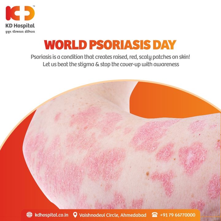 Stop hiding your skin; makeup and concealer are not the solutions but the right treatment is!
Let us beat the stigma and light rays of awareness to fight this disease.

#KDHospital #WorldPsoriasisDay #medicine #ClearSkin #Piel #SkinCare #Psoriasis #Dermatology #PsoriasisTips
#PsoriasisTreatment #sensitiveskin  #dryhands #handcream #dryskin #surgery #nurse #doctor #health #healthcare  #medical #physician #healthyskin #skin #wellness #wellnessthatworks #Ahmedabad #Gujarat #India