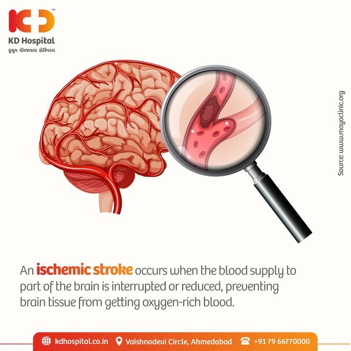 A stroke can cause life-altering, devastating changes like loss of speech, movement and memory. Medical professionals use the term 