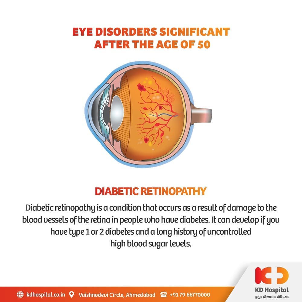 Diabetic retinopathy may take several years to the point it could blind your eye-sight if left untreated and undiagnosed. 

KD Hospital is having a free eye consultation from 17/11/2020 to 30/11/2020 for the patients above the age of 50. Call +918980280802 or +916359603634 between 9:00 AM to 5:00 PM to book an appointment. Additionally, we have Cashless Facilities available at the hospital. 

#KDHospital #eyecheckup #diabeticretinopathy #retinopathy #blindness #blind #cataractsurgery #blindnessawareness #DoctorsOfInstagram #Diagnosis #Therapeutics #goodhealth #pandemic #socialmedia #socialmediamarketing #digitalmarketing #wellness #wellnessthatworks #Ahmedabad #Gujarat #India