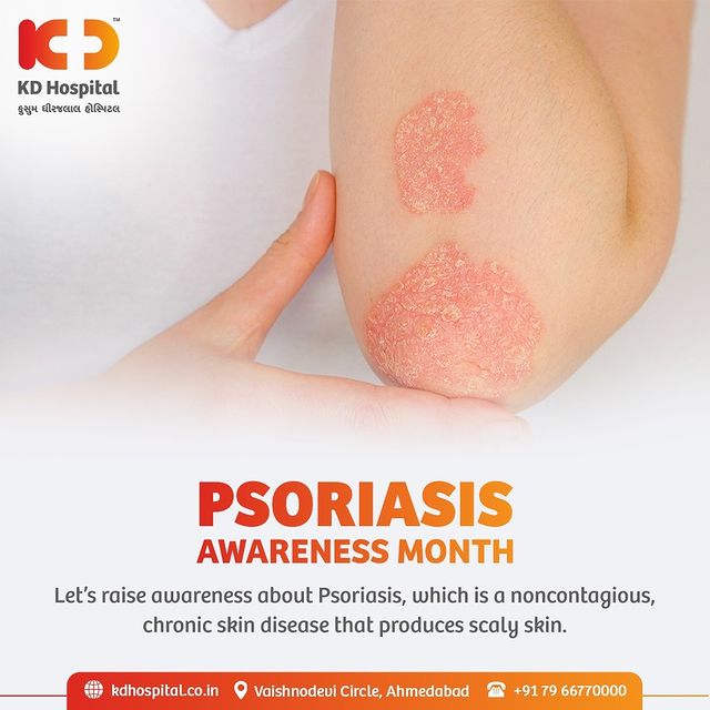 August is designated to be Psoriasis Awareness Month wherein awareness is raised for this chronic autoimmune disease with no cure.

#KDHospital #Psoriasis #PsoriasisAwarenessMonth #SkinDisease #SkinDisorder #Doctors #Diagnosis #Therapeutics #goodhealth #patienttestimonial #patient #testimonial #testimony #soical #socialmediamarketing #digitalmarketing #wellness #wellnessthatworks #Ahmedabad #Gujarat #India