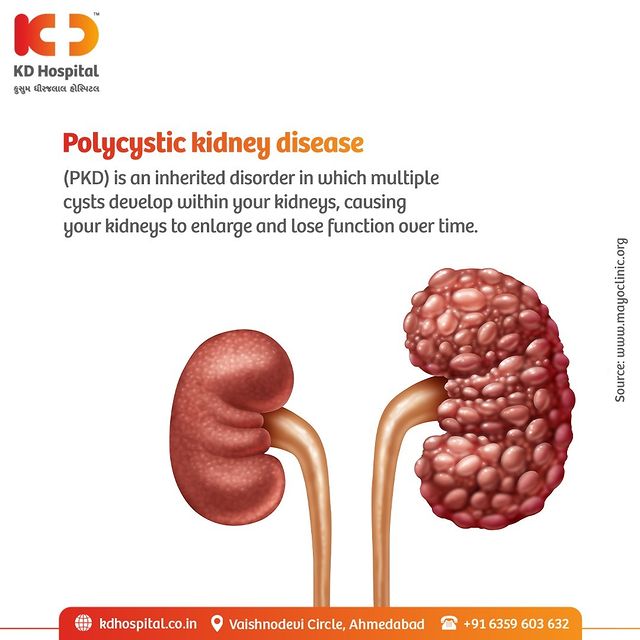 Polycystic kidney disease (PKD) is an inherited disorder in which clusters of cysts develop primarily within your kidneys, causing your kidneys to enlarge and lose function over time.
Get in touch with our renal experts to manage the fatal disease in a more effective manner & get a 50% discount on a Consultation by KD Hospital's expert Nephrologist. Offer valid till 30th November 2022 only. For appointments call Now on: +91 63596 03632.

#KDHospital #KidneyDisease #Nephrology #Kidney #Dialysis #AccuteKidneyDisease #ChronicKidneyDisease #Nephritis #UTI #Createnine #KidneyCyst #PolycysticKidney #DiabeticNephropathy #Nephrology #KidneyTransplant #kidneyhealth #kidneyfailure #interactivegrams #instagrameverywhere #diabetickidneydisease #YoursToMake #Ahmedabad #Gujarat #india