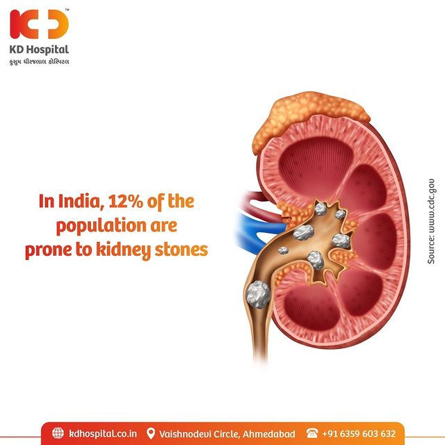 Kidney stones are hard deposits of minerals and acid salts that stick together in concentrated urine. They can be painful while passing through the urinary tract leading to Severe, sharp pain in the side and back, below the ribs. Pain that radiates to the lower abdomen and groin. Pain comes in waves and fluctuates in intensity.

Kidney stones can be your worst enemy so fight against them with efficacy. Visit our Kidney Disease Screening Camp & get a 50% discount on Consultation by KD Hospital's expert Nephrologist. For appointments Call Now on: +91 63596 03632.
Offer valid till 30th November 2022 only. 

#KDHospital #KidneyStones #KidneyDisease #Nephrology #Kidney #Dialysis #AccuteKidneyDisease #ChronicKidneyDisease #Nephritis #UTI #Createnine #KidneyCyst #PolycysticKidney #DiabeticNephropathy #Nephrology #KidneyTransplant #kidneyhealth #kidneyfailure #interactivegrams #instagrameverywhere #diabetickidneydisease #YoursToMake #Ahmedabad #Gujarat #india