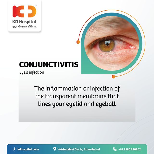 Ease the discomfort of pink eye- Conjunctivitis. 
Conjunctivitis, also known as 'Pink Eye' may try to blur your vision, but with a little care and awareness, we can see through the discomfort and emerge stronger than ever!  Together, let's uncover the symptoms, prevention, and risks involved and practise good hygiene to control the spread. 

For appointments, call on +91 8980280802.

#KDHospital #health #ConjunctivitisWarrior #EyeHealthMatters #SeeingClearlyAgain #StaySanitized #HealthAwareness #Compassion #Doctors #Diagnosis #Therapeutics #wellness #wellnessthatworks #Ahmedabad #glasses #eye #vision #doctor #optometry #optometrist #redeye #bacteria #eyehealth #ophthalmology #eyedoctor