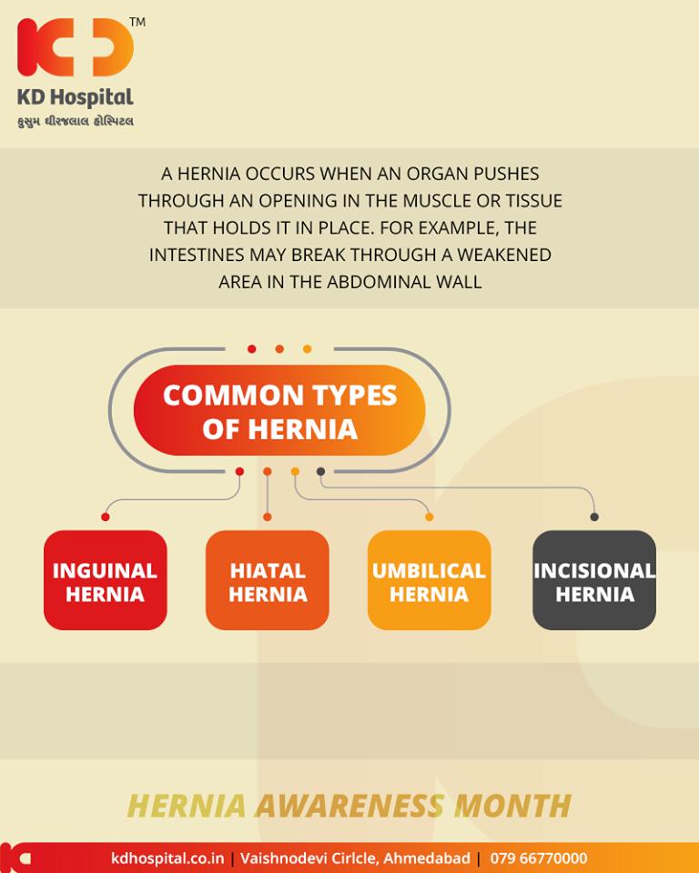 Hernias are most common in the abdomen, but they can also appear in the upper thigh, belly button, and groin areas. Most hernias aren’t immediately life-threatening, but they don’t go away on their own.

#Hernias #KDHospital #GoodHealth #Ahmedabad #Gujarat #India https://t.co/BZublOFSLS