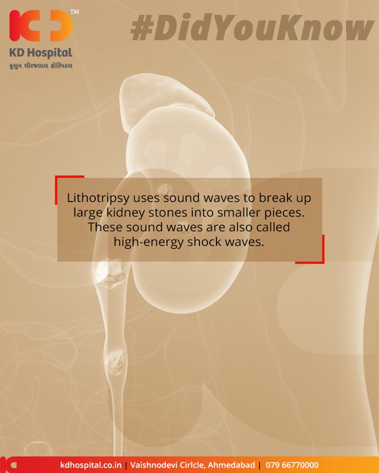 #DidYouKnow

#Lithotripsy uses sound waves to break up large #kidneystones into smaller pieces. These sound waves are also called high-energy shock waves.

#KDHospital #GoodHealth #Ahmedabad #Gujarat #India https://t.co/OJJHDqBnNI